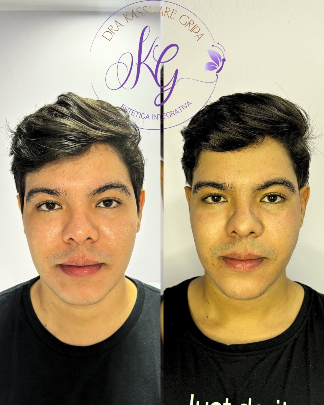 Registro fotográfico de antes e depois 4, fornecido pela clínica