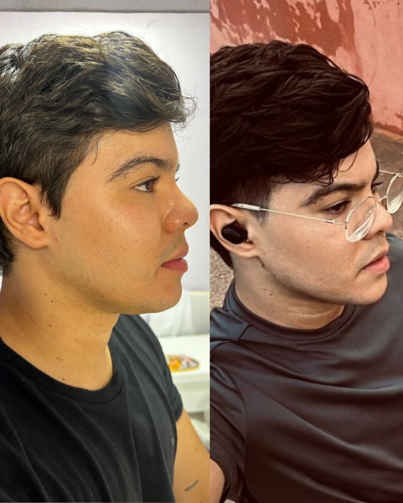 Registro fotográfico de antes e depois 7, fornecido pela clínica