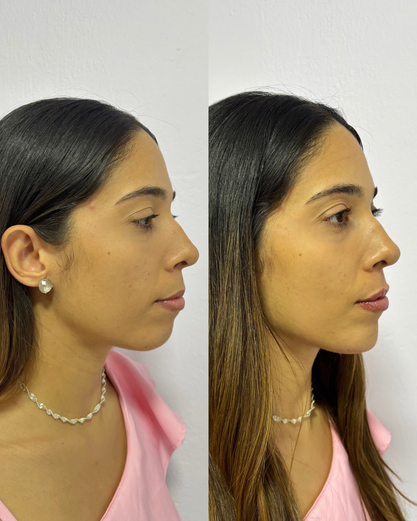 Registro fotográfico de antes e depois 9, fornecido pela clínica